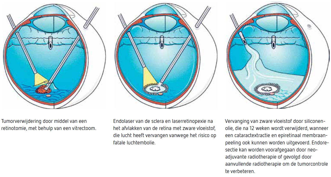 illustratie (kleur) verwijdering van tumor - retinotomie - Bertil Damato
