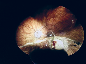 afbeelding (kleur) Endoresectie inferior van de macula met rondom lasercoagulaten.