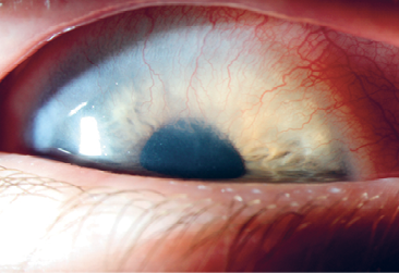 Foto (kleur) oog met keratoconjunctivitis met corneale vaatingroei